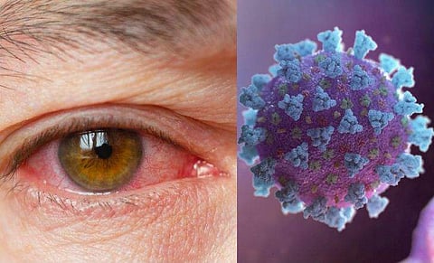 കണ്ണുകൾ പിങ്ക് നിറമാകുന്നത് കോവിഡ് ലക്ഷണം; ജാ​ഗ്രത വേണമെന്ന് പഠനം, മുന്നറിയിപ്പ്