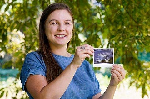 യുവതിക്ക് ഇരട്ട ​ഗർഭപാത്രം, രണ്ടിലും ഇരട്ട കുട്ടികൾ! അത്യപൂർവം