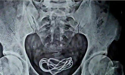 ലൈംഗിക സുഖത്തിന് 30കാരന്‍ രണ്ടടി നീളമുളള മൊബൈല്‍ ചാര്‍ജറിന്റെ കേബിള്‍ ജനനേന്ദ്രിയം വഴി ശരീരത്തിലേക്ക് കുത്തിക്കയറ്റി, ശസ്ത്രക്രിയ; അപൂര്‍വ്വ സംഭവം