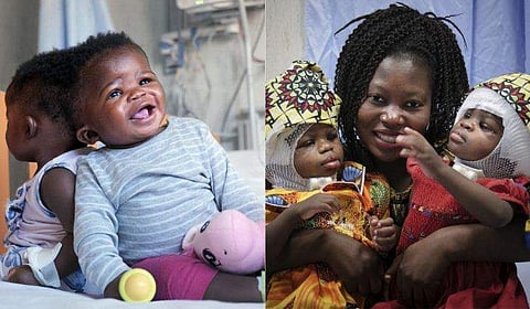 18 മണിക്കൂർ നീണ്ട ശസ്ത്രക്രിയ, തലയോട്ടി ഒട്ടിച്ചേർന്നു ജനിച്ച ഇരട്ടകളെ വേർപെടുത്തി; ചരിത്രത്തിൽ ആദ്യമെന്ന് വിദഗ്ധർ