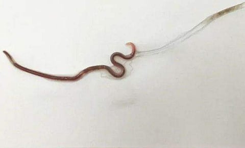 കടുത്ത തൊണ്ടവേദന, പരിശോധിച്ച ഡോക്ടർമാർ ഞെട്ടി; ജീവനുള്ള വിര