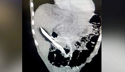 28കാരന്‍ 20 സെന്റിമീറ്റര്‍ നീളമുളള കത്തി വിഴുങ്ങി, മൂന്ന് മണിക്കൂര്‍ നീണ്ട അതിസങ്കീര്‍ണ ശസ്ത്രക്രിയ; കരളില്‍ നിന്ന് പുറത്തെടുത്തു