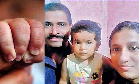 കോവിഡും വിഷപ്പാമ്പിന്റെ കടിയും അതിജീവിച്ച് ഒന്നരവയസ്സുകാരി, തിരികെ ജീവിതത്തിലേക്ക്