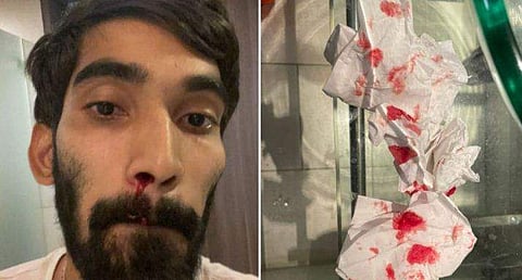 കോവിഡ് പരിശോധനയ്ക്ക് പിന്നാലെ മൂക്കില്‍ നിന്ന് രക്തം വാര്‍ന്ന് ഇന്ത്യയുടെ ബാഡ്മിന്റണ്‍ താരം കിഡംബി ശ്രീകാന്ത്‌/ഫോട്ടോ: ട്വിറ്റര്‍