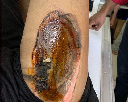 ട്വിറ്ററില്‍ പങ്കുവെച്ച പൊള്ളലേറ്റ ചിത്രം, image credit: Suhit Sharma @suhitrulz