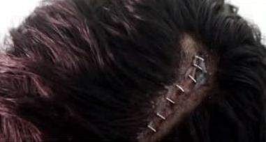 ആല്‍ബിന്റെ തലയ്ക്ക് പരിക്കേറ്റ നിലയില്‍