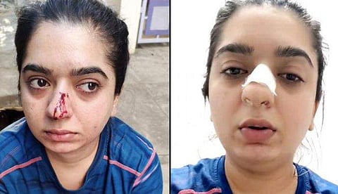 സൊമാറ്റോ ഡെലിവറി ബോയുടെ മര്‍ദ്ദനത്തില്‍ പരിക്കേറ്റ യുവതി / ചിത്രം ഇന്‍സ്റ്റഗ്രാം