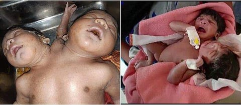 സയാമീസ് ഇരട്ടകൾ/ ട്വിറ്റർ