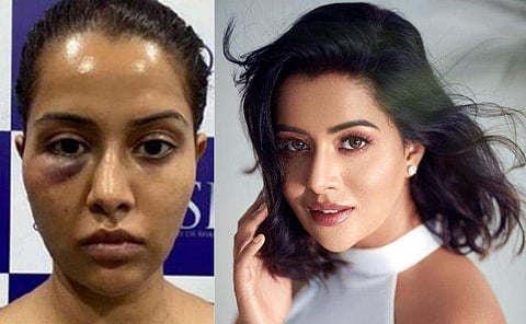 റെയ്സ വിൽസൺ ചികിത്സയ്ക്ക് ശേഷം/ ഇൻസ്റ്റ​ഗ്രാം