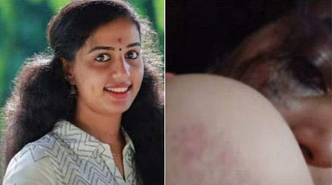 മരിച്ച വിസ്മയ, മർദനമേറ്റ ചിത്രങ്ങൾ / ടെലിവിഷൻ ചിത്രം