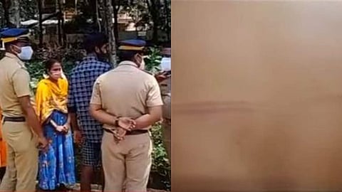 കാട്ടാക്കടയില്‍ പൊലീസിന്റെ മര്‍ദ്ദനമേറ്റ വിദ്യാര്‍ത്ഥിയുടെ ശരീരത്തിലെ പാട്
