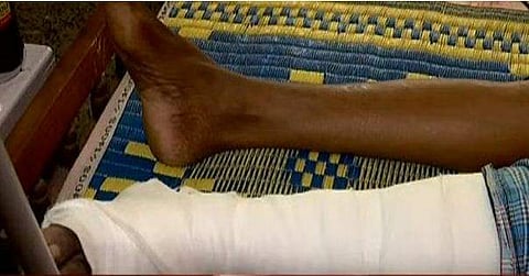 സ്ത്രീധനത്തിന്റെ പേരില്‍ യുവതിയുടെ അച്ഛന്റെ കാല്‍ തല്ലിയൊടിച്ച നിലയില്‍