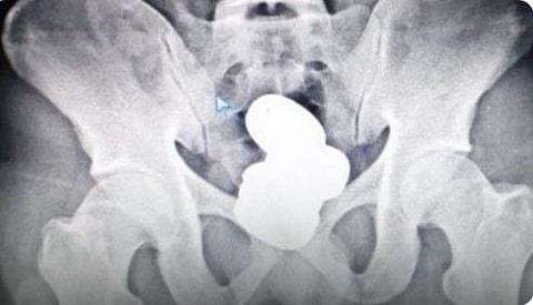 സ്വര്‍ണം മലദ്വാരത്തില്‍ ഒളിപ്പിച്ച നിലയില്‍ / ട്വിറ്റര്‍ ചിത്രം