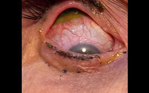 കണ്ണില്‍ നിന്ന് കോണ്‍ടാക്ട് ലെന്‍സ് നീക്കം ചെയ്യുന്ന ദൃശ്യം