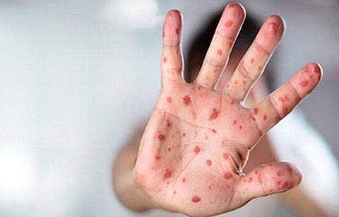 മലപ്പുറത്തെ അഞ്ചാംപനി വ്യാപനം; കേന്ദ്ര സംഘം ഇന്ന് ജില്ലയിലെത്തും