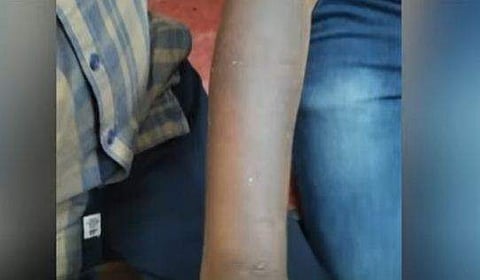 വിദ്യാര്‍ഥിയുടെ കൈയ്ക്ക് പൊള്ളലേറ്റ നിലയില്‍