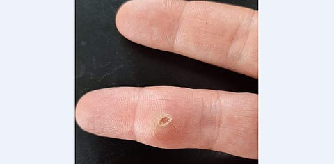 പാമ്പിന്റെ പല്ല് വിരലില്‍ നിന്ന് പുറത്തെടുത്തപ്പോള്‍