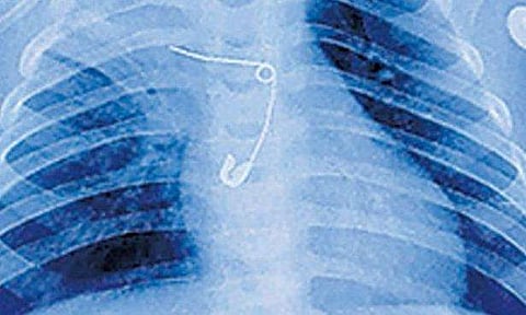 സുചി വിഴുങ്ങിയ കുഞ്ഞിന്റെ എക്‌സറേ ചിത്രം