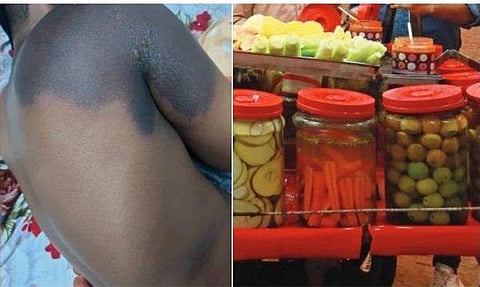 പൊള്ളലേറ്റ നിലയിൽ കുട്ടി/ ടെലിവിഷൻ ദൃശ്യം