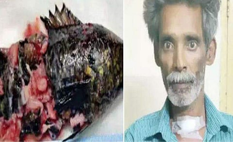 ചൂണ്ടയിടുന്നതിനിടെ മീന്‍ തൊണ്ടയില്‍ കുടുങ്ങി; 12 സെമീ നീളമുണ്ടായ മത്സ്യത്തെ പുറത്തെടുത്തു