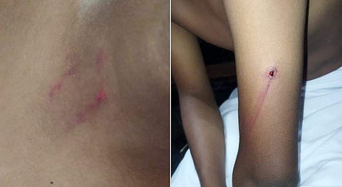 മർദ്ദനത്തിൽ കുട്ടിയ്ക്കേറ്റ പരിക്ക്