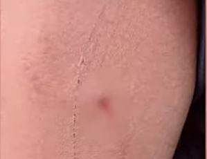 തെരുവുനായയുടെ ആക്രമണത്തില്‍ കുട്ടിക്ക് പരിക്കേറ്റപ്പോള്‍