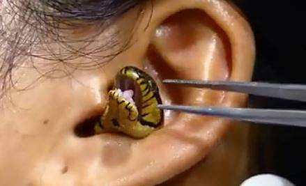 യുവതിയുടെ ചെവിയില്‍ കുടുങ്ങിയ പാമ്പിനെ പുറത്തെടുക്കാന്‍ ശ്രമിക്കുന്ന ദൃശ്യം