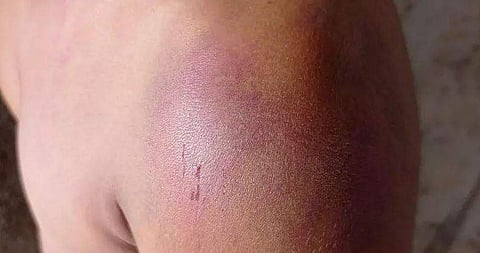 കുട്ടിയുടെ ശരീരത്തിലെ പരിക്കേറ്റ പാടുകള്‍