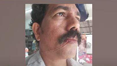 കേബിള്‍ കഴുത്തില്‍ കുരുങ്ങി പരിക്കേറ്റ ശ്രീനിവാസന്‍