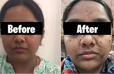 ഫേഷ്യൽ ചെയ്യുന്നതിന് മുൻപും ശേഷവും/ ട്വിറ്റർ