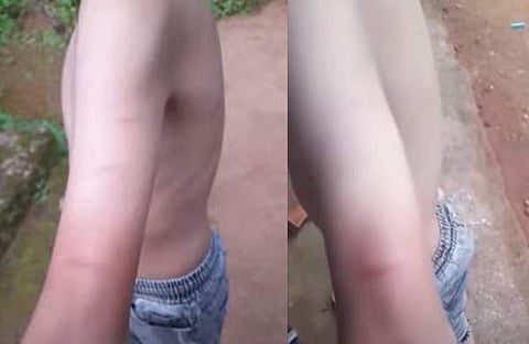 കുട്ടിക്ക് മര്‍ദനമേറ്റതിന്റെ പാടുകള്‍