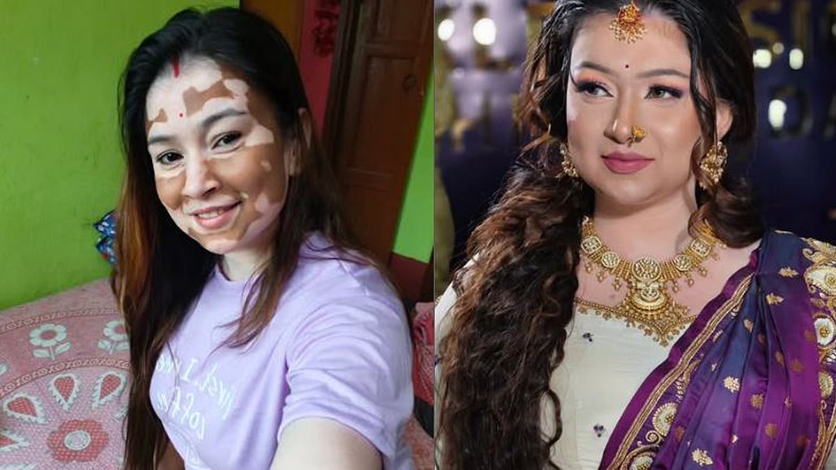 മുറിവ് ഉണങ്ങിയപ്പോഴാണ് വെള്ളപ്പാണ്ട് തിരിച്ചറിയുന്നത്, ബസില്‍ ഇരിക്കാന്‍ പോലും അനുവദിച്ചിരുന്നില്ല