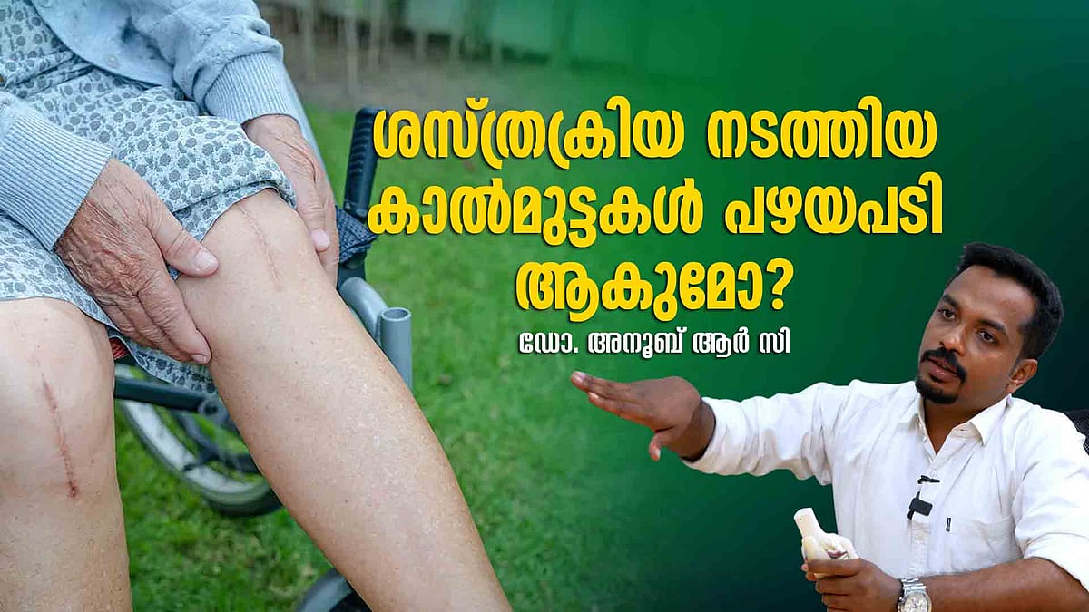 ചമ്രം പടിഞ്ഞിരുന്ന് സദ്യ കഴിക്കാന്‍ പറ്റില്ല!; മുട്ടു മാറ്റിവയ്ക്കല്‍ ശസ്ത്രക്രിയ, അറിഞ്ഞിരിക്കണം ഇക്കാര്യങ്ങള്‍
