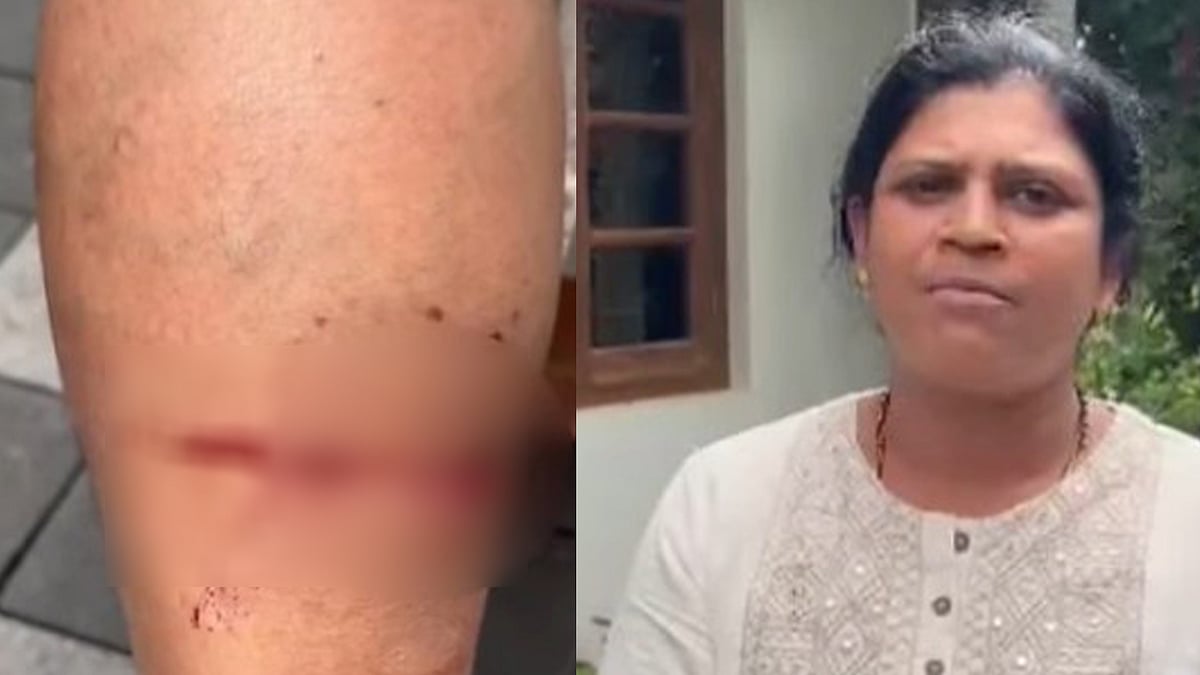 വോട്ടുതേടിയെത്തി; സ്ഥാനാര്‍ഥിയെ വളര്‍ത്തുനായ ഓടിച്ചിട്ട് കടിച്ചു