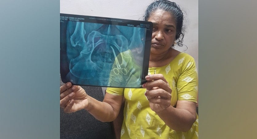 ശസ്ത്രക്രിയ അഞ്ചുവര്‍ഷം മുന്‍പ്; വയറുവേദനയ്ക്ക് മാറ്റമില്ല; കണ്ടെത്തിയത് 'കത്രിക'