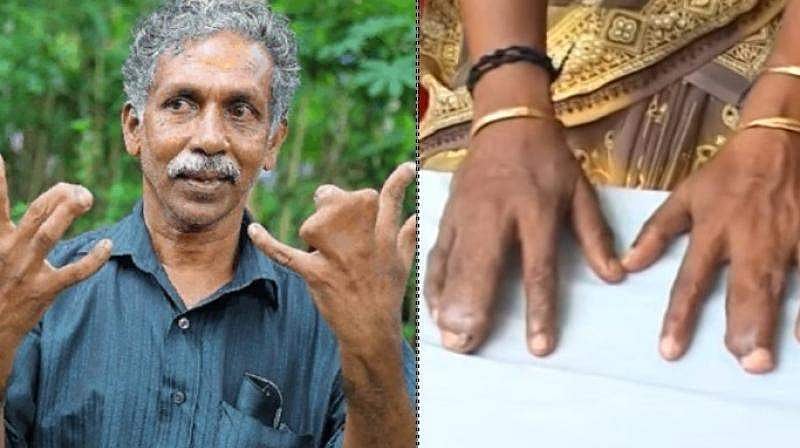 ഒട്ടിച്ചേര്‍ന്ന് വിരലുകളുമായി കുടുംബം; സര്‍പ്പ കോപമെന്ന് പറഞ്ഞ് ചികിത്സ വേണ്ടെന്നു വച്ചു