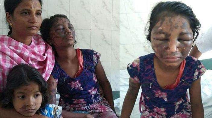 കുടുംബ വഴക്കിനിടെ ആസിഡ് ആക്രമണം; 12 കാരിയുടെ കണ്ണിന്റെ നില ഗുരുതരം