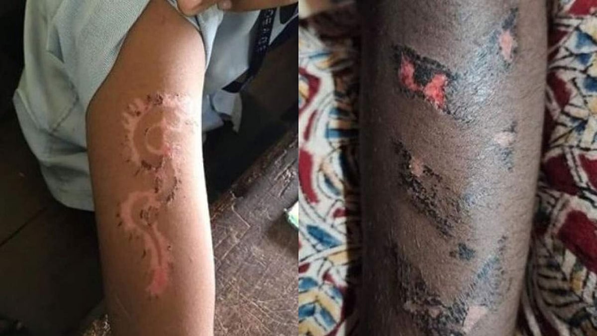 ടാറ്റൂ പതിച്ച കുട്ടികള്‍ക്ക് പൊളളലേറ്റു; ഇന്‍സ്റ്റന്റ് മൈലാഞ്ചി വില്ലനായി, നടപടി 