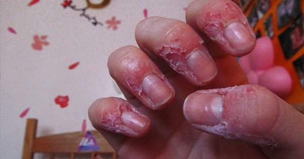 ഭക്ഷണം പാചകം ചെയ്യാന് വൈകി; മരുമകളുടെ വിരലുകള് കടിച്ചുപൊട്ടിച്ച് അമ്മായിയമ്മ