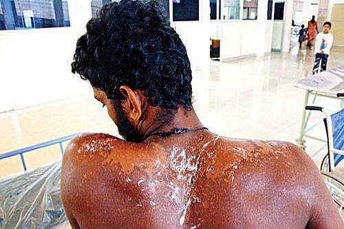 സൂര്യാഘാതം സംസ്ഥാന ദുരന്ത പട്ടികയില്: ഇരകള്ക്ക് നഷ്ടപരിഹാരം, ഈ മാസം അവസാനത്തോടെ ചൂട് കൂടും; ജാഗ്രത പാലിക്കണമെന്ന് ദുരന്ത നിവാരണ അതോറിറ്റി