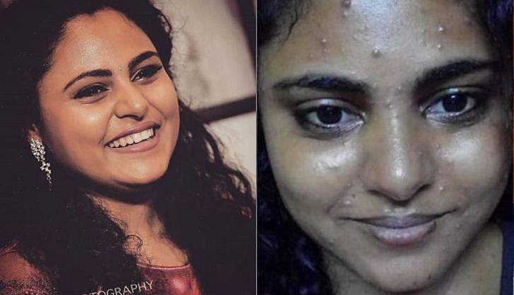ചിക്കന്‍പോക്‌സ് ബാധിച്ച മുഖത്തിന്റെ ചിത്രം പങ്കുവെച്ച് നടി; ചങ്കൂറ്റത്തിന് കയ്യടിച്ച് സോഷ്യല്‍ മീഡിയ