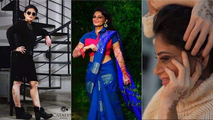 നിറത്തിലെന്തു കാര്യം, ആത്മവിശ്വാസമാണ് അഴക്; ലൂക്കോഡർമ മോഡലായി മഞ്ജുവിന്റെ ഫോട്ടോഷൂട്ട്