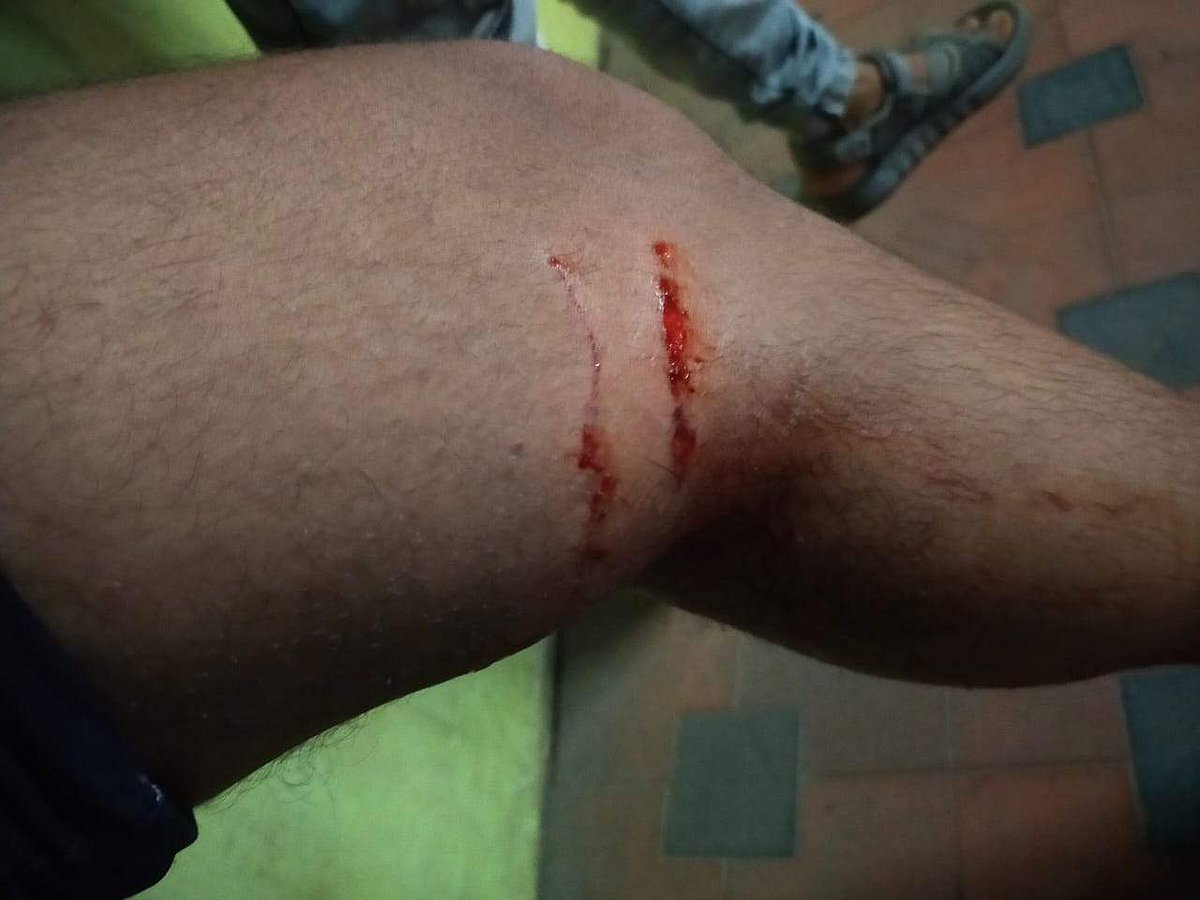 നാട്ടുകാരെ തെരുവ് നായ ഓടിച്ചിട്ടു ആക്രമിച്ചു; സ്ത്രീകളും കുട്ടികളുമടക്കം 20 പേര്‍ക്ക് പരിക്കേറ്റു