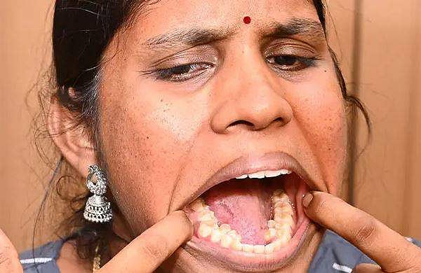 വായില്‍ എത്ര പല്ലുണ്ട്? എന്നാല്‍ എണ്ണിക്കോ, ഗിന്നസ് റെക്കോര്‍ഡ് നേടി ഇന്ത്യക്കാരി 